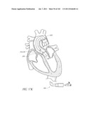 PROFILE REDUCTION OF VALVE IMPLANT diagram and image