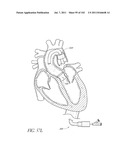 PROFILE REDUCTION OF VALVE IMPLANT diagram and image