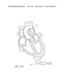 PROFILE REDUCTION OF VALVE IMPLANT diagram and image