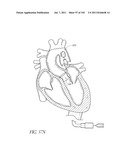 PROFILE REDUCTION OF VALVE IMPLANT diagram and image