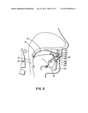 INTRA-ORAL APPLIANCE FOR TREATMENT OF SLEEP DISORDERS diagram and image