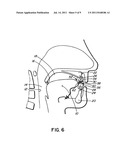 INTRA-ORAL APPLIANCE FOR TREATMENT OF SLEEP DISORDERS diagram and image