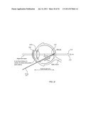 ORTHOVOLTAGE RADIOSURGERY diagram and image