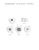 ORTHOVOLTAGE RADIOSURGERY diagram and image