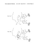 ORTHOVOLTAGE RADIOSURGERY diagram and image