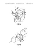 ADDITIONAL STABILIZATION DEVICE FOR ENDO-OSSEOUS DENTAL IMPLANT diagram and image