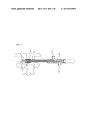 INTERSPINOUS PROCESS SPACER DIAGNOSTIC BALLOON CATHETER AND METHODS OF USE diagram and image