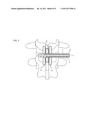 INTERSPINOUS PROCESS SPACER DIAGNOSTIC BALLOON CATHETER AND METHODS OF USE diagram and image