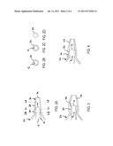 CATHETER HAVING A SOFT DISTAL TIP diagram and image