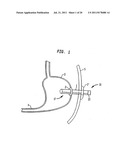 Shunt Apparatus For Treating Obesity By Extracting Food diagram and image