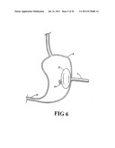 Shunt Apparatus For Treating Obesity By Extracting Food diagram and image