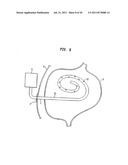 Shunt Apparatus For Treating Obesity By Extracting Food diagram and image