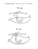 Shunt Apparatus For Treating Obesity By Extracting Food diagram and image