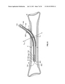 ROTARY-RIGID ORTHOPAEDIC ROD diagram and image