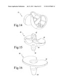 KNEE PROSTHESIS SYSTEM diagram and image