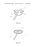 ADJUSTABLE ORAL INTERFACE AND METHOD TO MAINTAIN UPPER AIRWAY PATENCY diagram and image