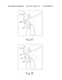 ADJUSTABLE ORAL INTERFACE AND METHOD TO MAINTAIN UPPER AIRWAY PATENCY diagram and image