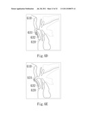 ADJUSTABLE ORAL INTERFACE AND METHOD TO MAINTAIN UPPER AIRWAY PATENCY diagram and image