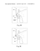 ADJUSTABLE ORAL INTERFACE AND METHOD TO MAINTAIN UPPER AIRWAY PATENCY diagram and image