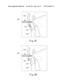 ADJUSTABLE ORAL INTERFACE AND METHOD TO MAINTAIN UPPER AIRWAY PATENCY diagram and image