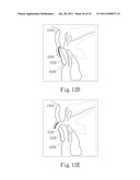 ADJUSTABLE ORAL INTERFACE AND METHOD TO MAINTAIN UPPER AIRWAY PATENCY diagram and image