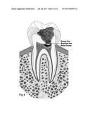 MEDICAL AND DENTAL BIOMATERIAL AND METHOD OF USE FOR THE SAME diagram and image