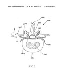 DEVICE AND METHOD FOR MINIMALLY INVASIVE SPINAL INTERVENTION diagram and image