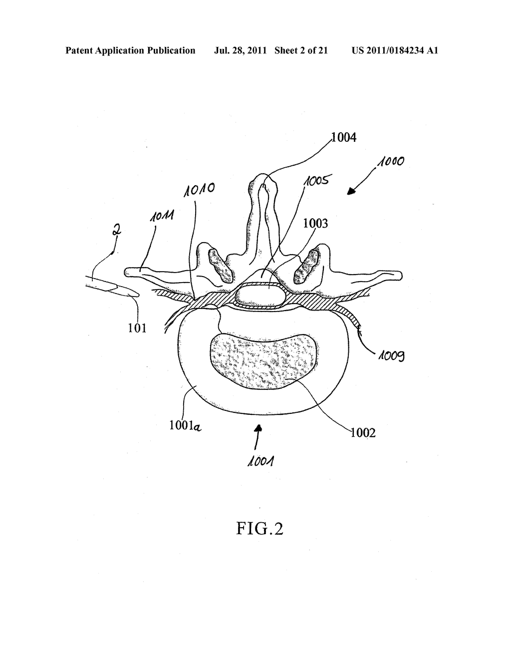 DEVICE AND METHOD FOR MINIMALLY INVASIVE SPINAL INTERVENTION - diagram, schematic, and image 03