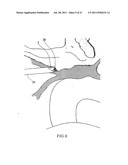 DEVICE AND METHOD FOR MINIMALLY INVASIVE SPINAL INTERVENTION diagram and image