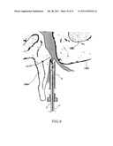 DEVICE AND METHOD FOR MINIMALLY INVASIVE SPINAL INTERVENTION diagram and image