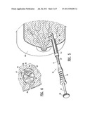 INTRACORPOREAL MARKER AND MARKER DELIVERY DEVICE diagram and image