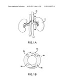 Methods and devices for denervation diagram and image