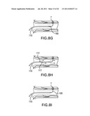 Methods and devices for denervation diagram and image