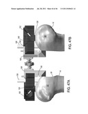 Instrumentation for Implants with Transition Surfaces and Related     Processes diagram and image