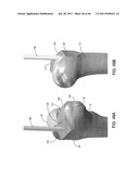 Instrumentation for Implants with Transition Surfaces and Related     Processes diagram and image