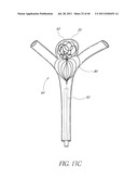 VASCULAR REMODELING DEVICE diagram and image