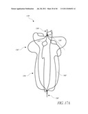 VASCULAR REMODELING DEVICE diagram and image