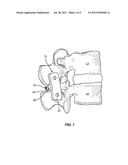 SPINOUS PROCESS FUSION PLATE WITH OSTEOINTEGRATION INSERT diagram and image