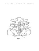 SPINOUS PROCESS FUSION PLATE WITH OSTEOINTEGRATION INSERT diagram and image