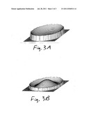 INTRAOCULAR MENISCUS LENS PROVIDING PSEUDO-ACCOMMODATION diagram and image