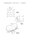 PATIENT-MODIFIED IMPLANT diagram and image