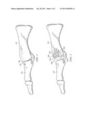 Resurfacing Implant diagram and image