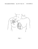 REDUCTION OF INFECTION ASSOCIATED WITH MEDICAL DEVICE diagram and image