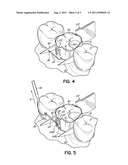 DENTAL MATRIX BAND diagram and image