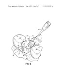 DENTAL MATRIX BAND diagram and image