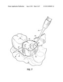 DENTAL MATRIX BAND diagram and image