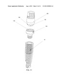 METHOD AND SYSTEM FOR DENTAL IMPLANTATION diagram and image