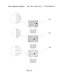 METHOD AND SYSTEM FOR DENTAL IMPLANTATION diagram and image