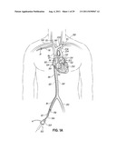 METHODS OF SECURING A CANNULA ASSEMBLY, IMPLANTING A CIRCULATORY ASSIST     SYSTEM AND CROSSING A TISSUE BARRIER diagram and image