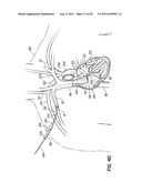 METHODS OF SECURING A CANNULA ASSEMBLY, IMPLANTING A CIRCULATORY ASSIST     SYSTEM AND CROSSING A TISSUE BARRIER diagram and image